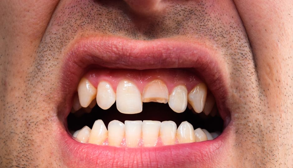 Broken Teeth