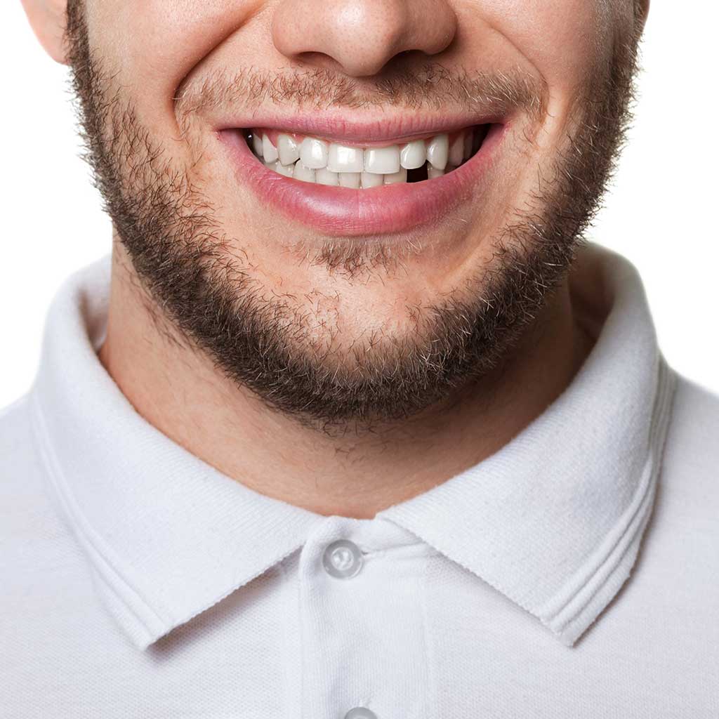 Missing Teeth