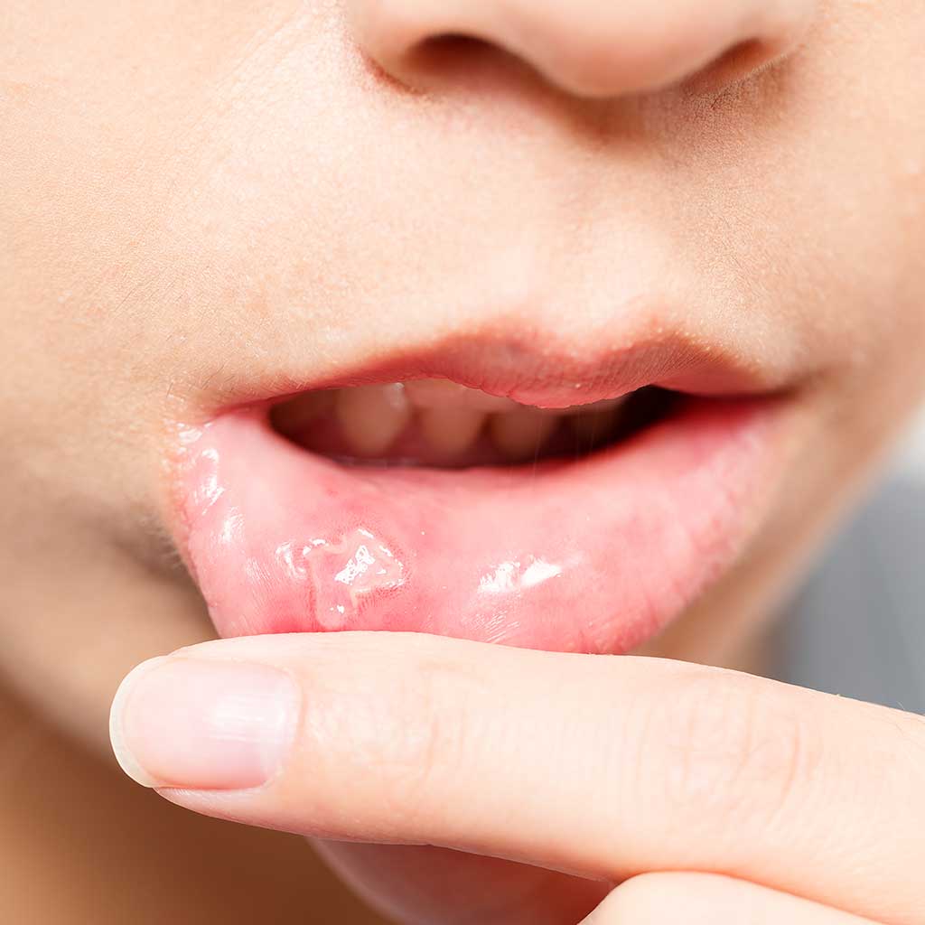 Mouth Ulcers