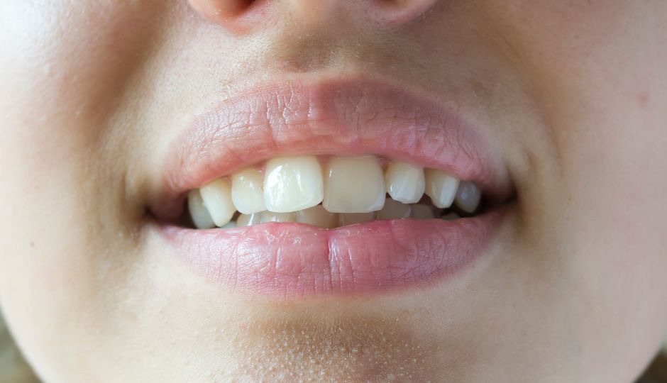 Crooked & Misaligned Teeth