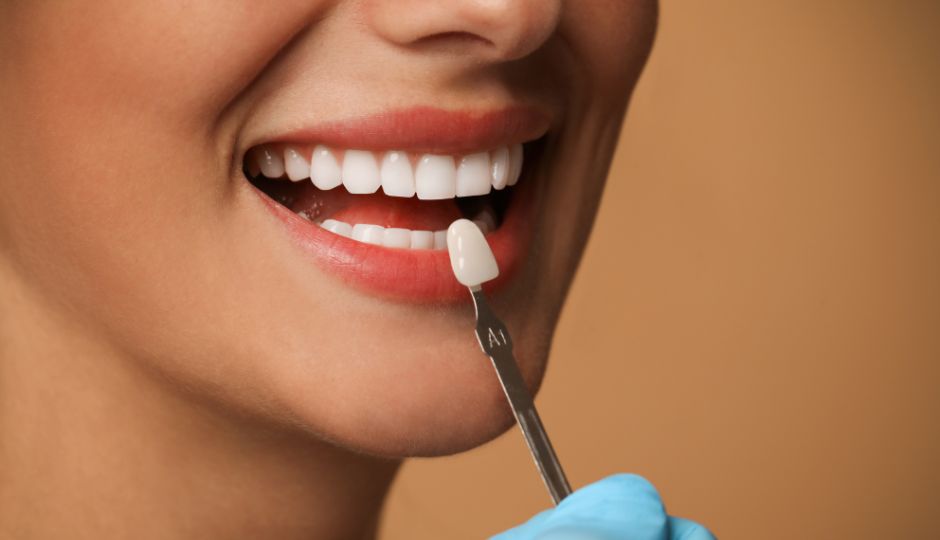 Dental Veneers