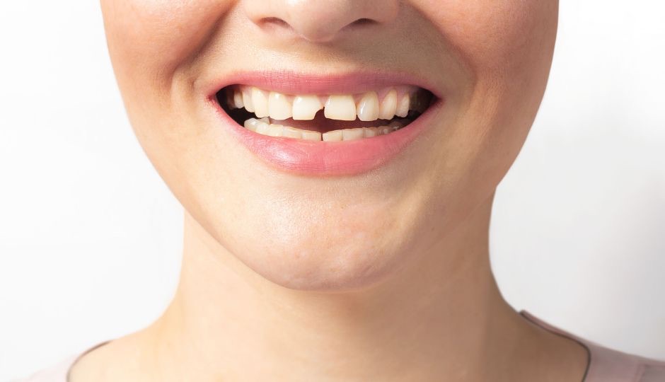 Broken Teeth