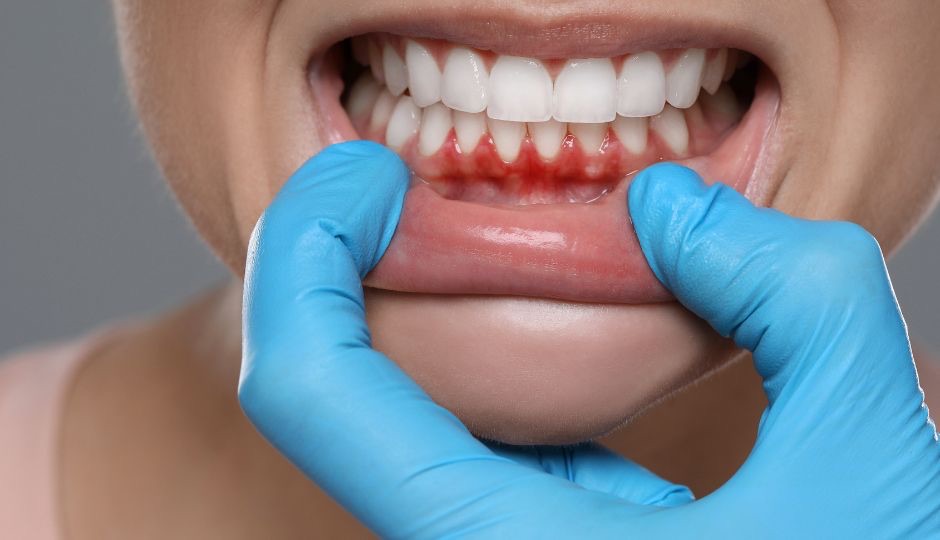 Gingivitis