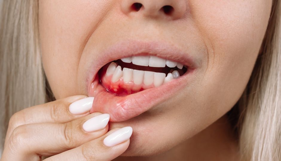 Ulcers